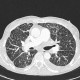 Interstitial edema of the lung: CT - Computed tomography